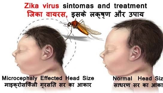 zika-virus-symptoms-in-hindi.